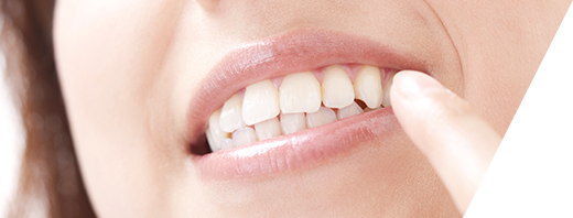 ホワイトニング